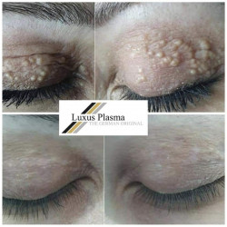 07.Удаление сирингомы и ксантелазмы ( Luxus Plasma Liner) от 500 ₪ Запись через WhatsApp 