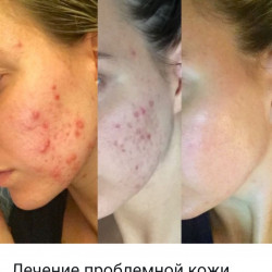 03.Лечение акне Кармиэль