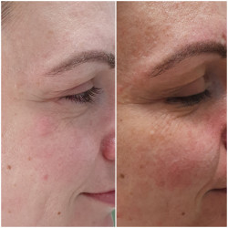 13.Омоложение кожи лица — результат после процедур