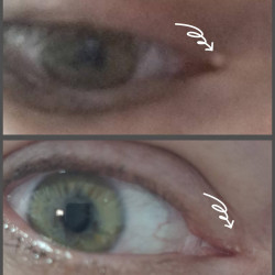 05.Лифтинг лица после серии процедур микроигольчатого RF-лифтинга — разглаживание морщин и омоложение кожи