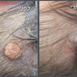 06.Удаление крупного новообразования в волосистой части головы холодной плазмой - результат процедуры