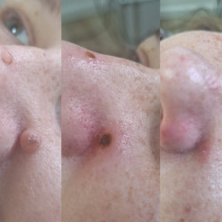 08.Удаление папиллом и новообразований холодной плазмой OSMO Plasma - до и после процедуры, An Cosmetics Ришон-ле-Цион