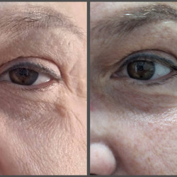 02.Холодная плазма OSMO Plasma - омоложение, удаление пигментации и папиллом, результат процедур Элеоноры An Cosmetics