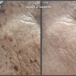 07.Чистка кожи от различных новообразований после процедур холодной плазмы - уход у косметолога Элеоноры в Ришон-ле-Ционе