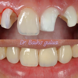 17.Реставрация зубов в Грузии -стоматология недорого