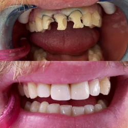 10.Эстетическая стоматология Грузии - реставрация зубов