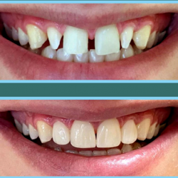 09.Художественная реставрация зубов в Тбилиси - восстановление и белизна