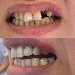 16.Коронки на имплантах в Грузии - надёжное восстановление