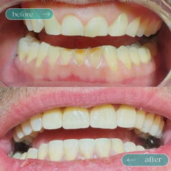 11.Лечение и реставрация зубов в Грузии по доступным ценам