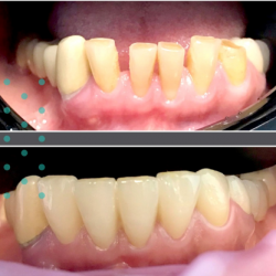 15.Коронки из циркония - стоматология в Тбилиси