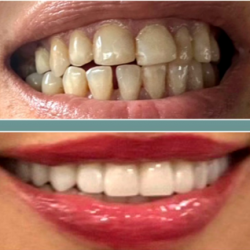 19.Тотоальная реабилитация зубов - циркониевые коронки в Грузии