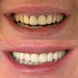 13.Пресс-керамические виниры в Грузии - красивая улыбка