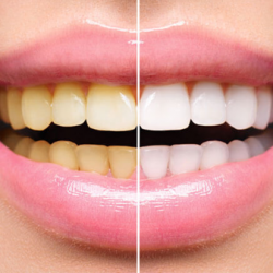 02.Отбеливание и уход за зубами в Тбилиси