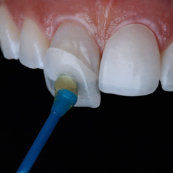 03.Виниры в Грузии - эстетика и идеальная улыбка