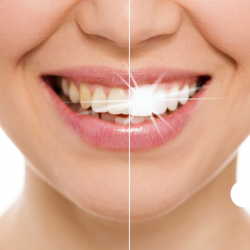 01.Отбеливание зубов в Грузии - стоматология недорого