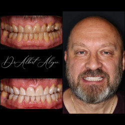 14.Профессиональное отбеливание зубов фото