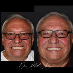 17.Протезирование зубов на имплантах