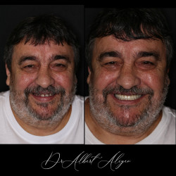 06.Протезирование зубов на имплантах