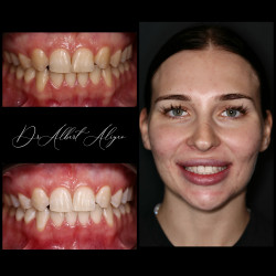 13.Химическое отбеливание зубов результат