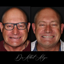 12.Установка зубных коронок Бат-Ям