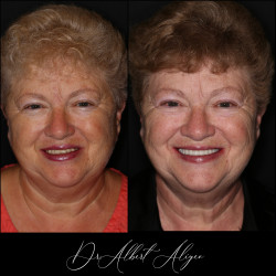 19.Протезирование на имплантах результат