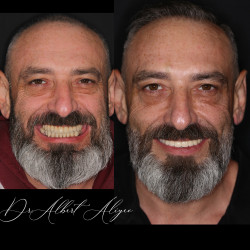 08.Протезирование на имплантах Бат-Ям