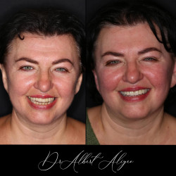 22.Протезирование зубов на имплантах до и после