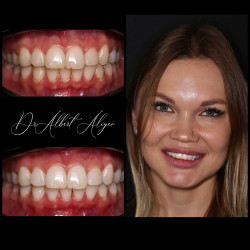 15.Отбеливание системой ZOOM результат