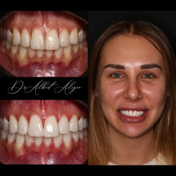 05.Профессиональное отбеливание зубов ZOOM