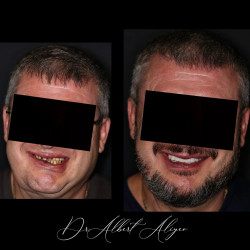 11.Коронки цирконий установка коронок