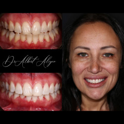 10.Отбеливание системой ZOOM4 Бат-Ям