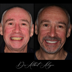 21.Протезирование на имплантах до и после