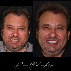 23.Протезирование на имплантах восстановление