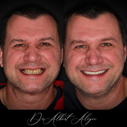 18.Коронки из диоксида циркония