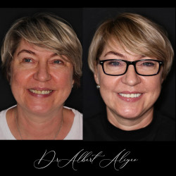 07.Протезирование коронками из диоксида циркония 