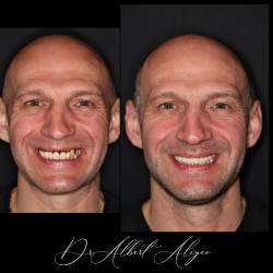 24.Имплантация и протезирование результат